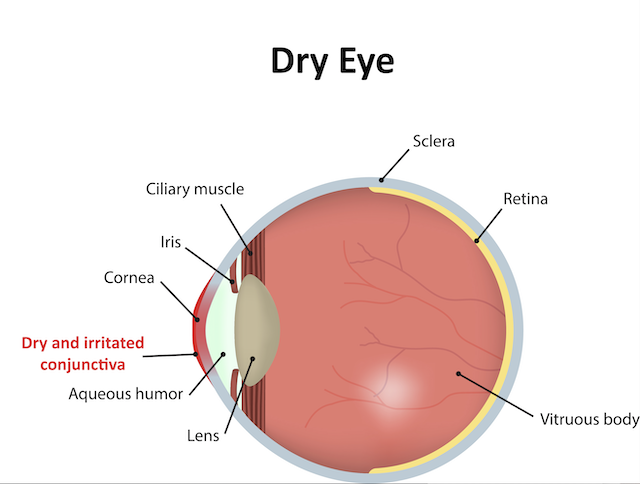 Infographic on Dry Eyes