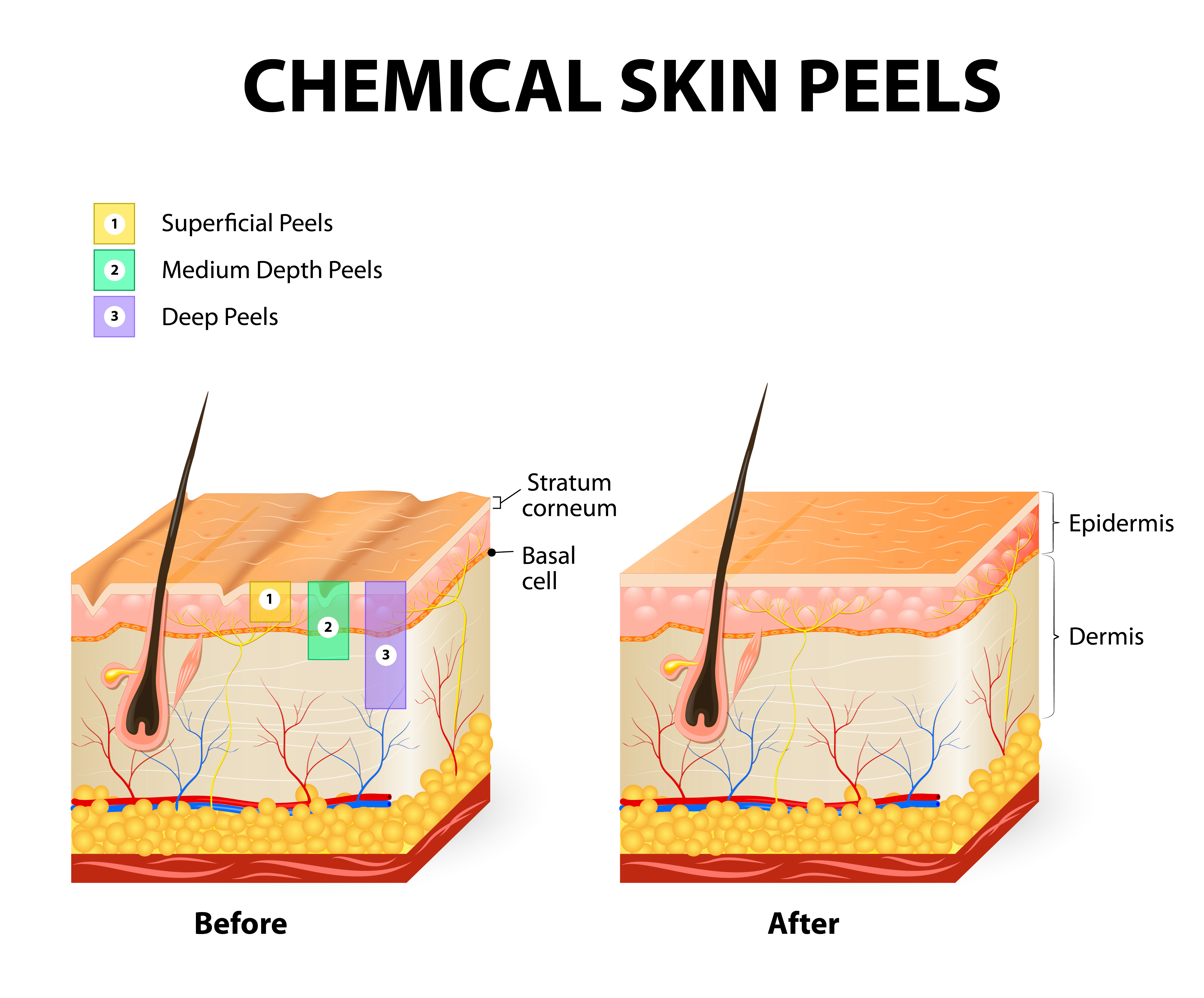 Chemical skin peels