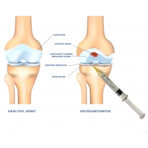 Sodium Hyaluronate for Joint Health