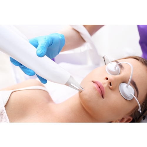 Pulsed dye laser for acne