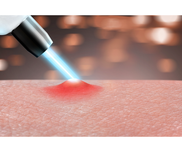 Infrared laser for acne